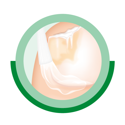 Ciclopoli Icon UmliegendeHautSymbol eines Nagels mit Pilz, das Produkt wird auf die Nagelhaut aufgetragen