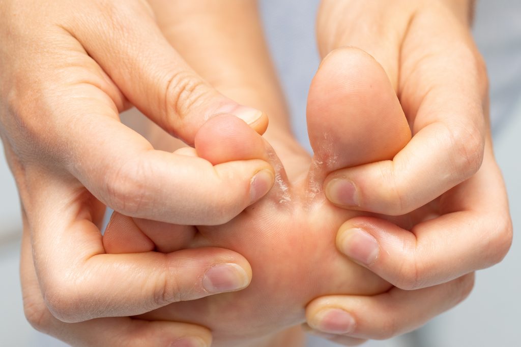 Nahaufnahme eines Fußpilzes zwischen den Zehen. Dieser befällt nur die Haut, im Gegensatz zum Nagelpilz.