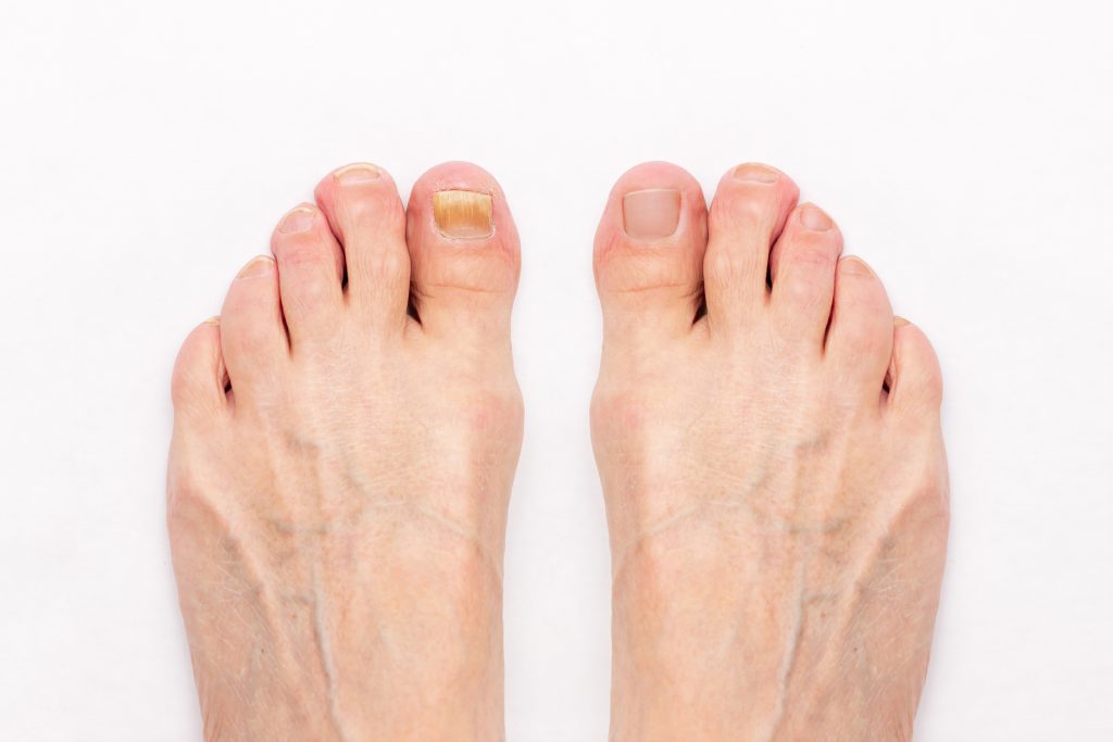 Nahaufnahme eines Nagelpilzes. Dieser tritt nur auf dem Nagel auf, ganz anders der Fußpilz, der häufig die Haut zwischen den Zehen befällt.
